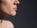 Skóra z widocznymi zmianami, zaczerwienieniami i krostkami. To jest trądzik, który może pojawić się na twarzy i innych częściach ciała.
