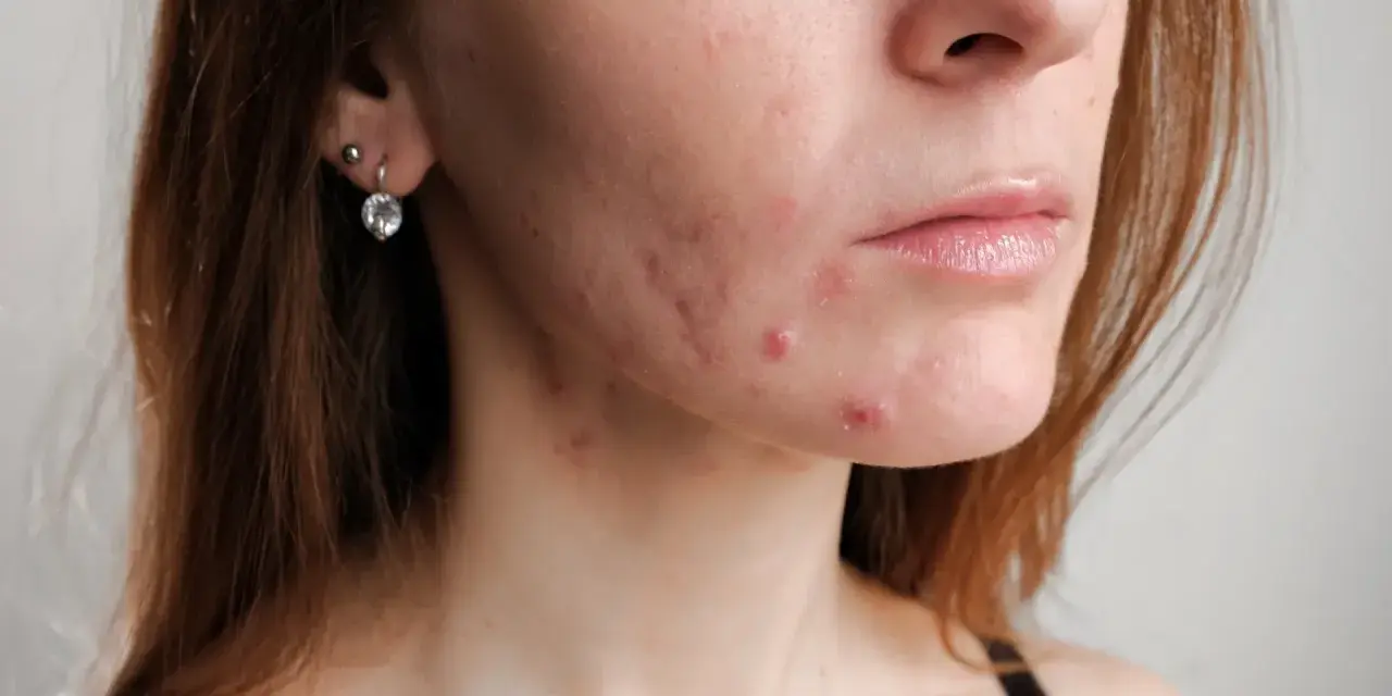 Skóra kobiety po 30. z widocznym trądzikiem hormonalnym na policzku i brodzie.