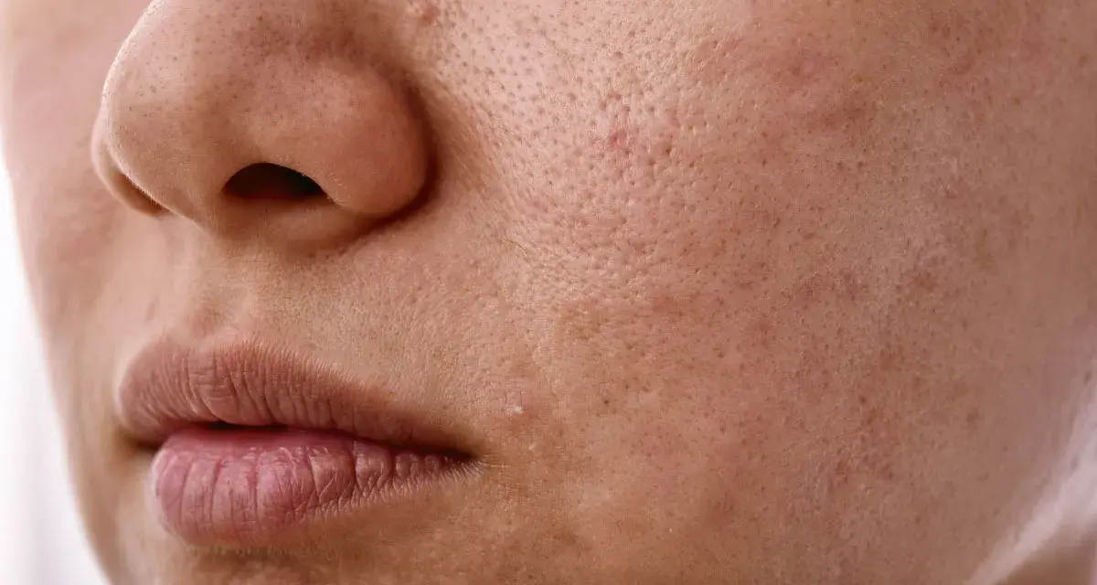 Skóra z widocznymi porami i niedoskonałościami. Zastanawiasz się, sebum co to? To naturalny tłuszcz skóry, który może powodować problemy.