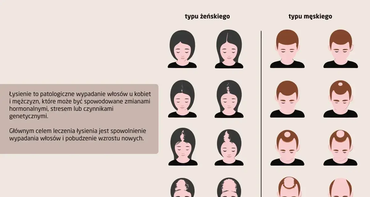 Ilustracja pokazuje różne etapy łysienia u kobiet i mężczyzn. Wypadanie włosów może mieć różne przyczyny.