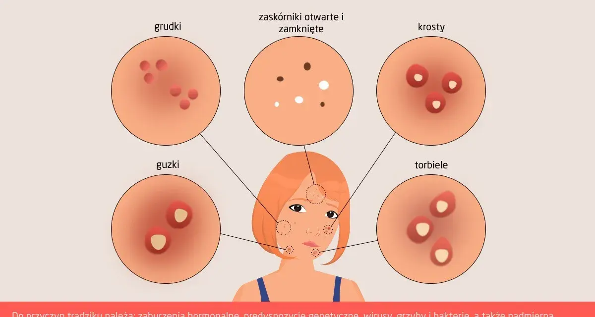Ilustracja pokazuje różne rodzaje trądziku, w tym pryszcze na policzkach, ich przyczyny i skutki.