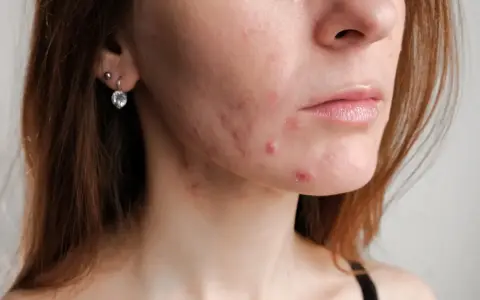Skóra kobiety po 30. z widocznym trądzikiem hormonalnym na policzku i brodzie.