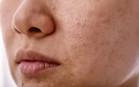 Skóra z widocznymi porami i niedoskonałościami. Zastanawiasz się, sebum co to? To naturalny tłuszcz skóry, który może powodować problemy.