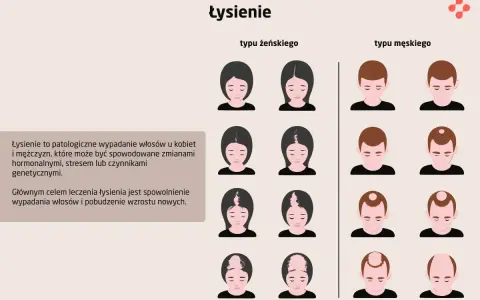 Ilustracja pokazuje różne etapy łysienia u kobiet i mężczyzn. Wypadanie włosów może mieć różne przyczyny.