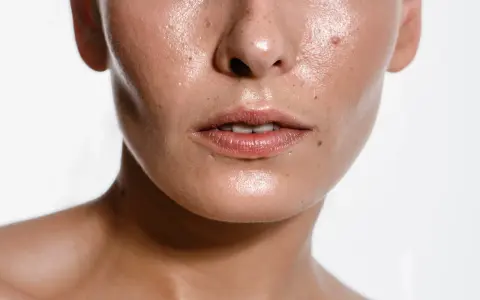 Błyszcząca skóra z widocznymi porami i piegami. Nadmiar sebum może być spowodowany czynnikami genetycznymi lub hormonalnymi.