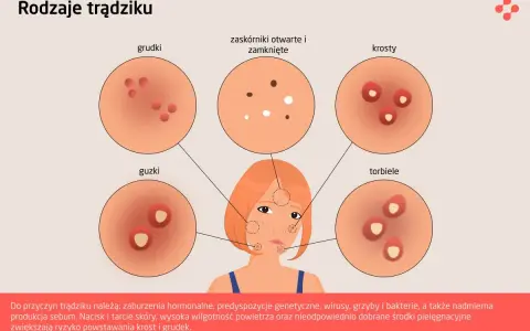 Ilustracja pokazuje różne rodzaje trądziku, w tym pryszcze na policzkach, ich przyczyny i skutki.