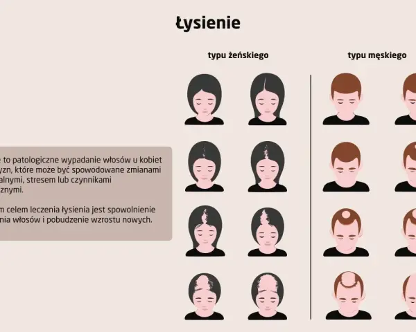 Ilustracja pokazuje różne etapy łysienia u kobiet i mężczyzn. Wypadanie włosów może mieć różne przyczyny.