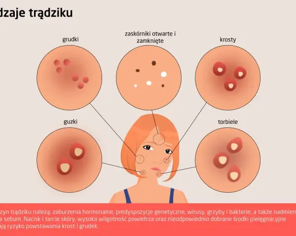 Ilustracja pokazuje różne rodzaje trądziku, w tym pryszcze na policzkach, ich przyczyny i skutki.