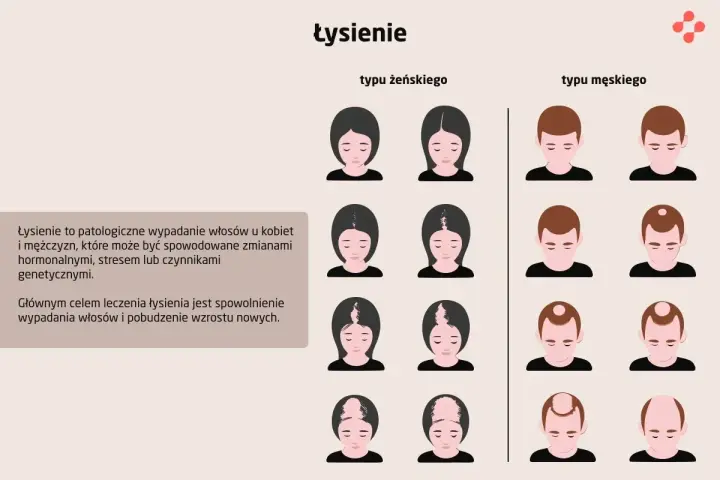 Ilustracja pokazuje różne etapy łysienia u kobiet i mężczyzn. Wypadanie włosów może mieć różne przyczyny.