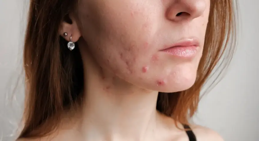 Skóra kobiety po 30. z widocznym trądzikiem hormonalnym na policzku i brodzie.