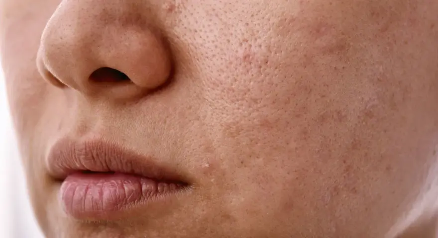 Skóra z widocznymi porami i niedoskonałościami. Zastanawiasz się, sebum co to? To naturalny tłuszcz skóry, który może powodować problemy.