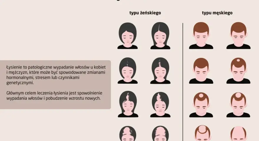 Ilustracja pokazuje różne etapy łysienia u kobiet i mężczyzn. Wypadanie włosów może mieć różne przyczyny.