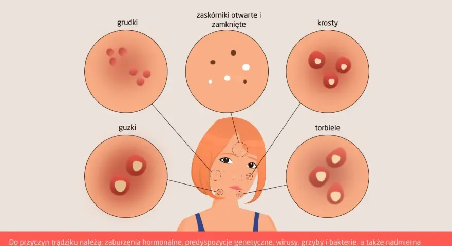 Ilustracja pokazuje różne rodzaje trądziku, w tym pryszcze na policzkach, ich przyczyny i skutki.