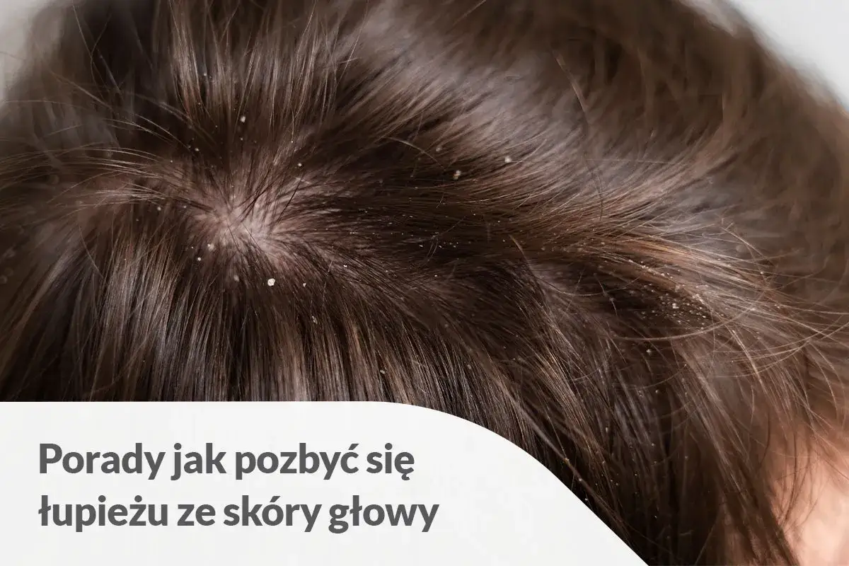 Sk&oacute;ra głowy z widocznym, suchym łupieżem. Białe płatki osypują się między ciemnymi włosami, wskazując na problem, kt&oacute;ry wymaga uwagi.